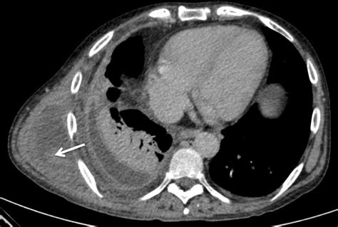 Spontaneous Muscle Haematoma In A Patient With Cirrhosis Bmj Case Reports