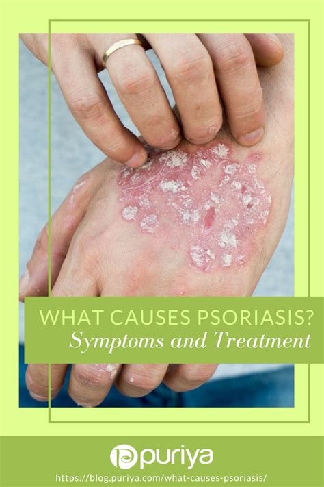 What Causes Psoriasis Symptoms And Treatment Puriya Blog