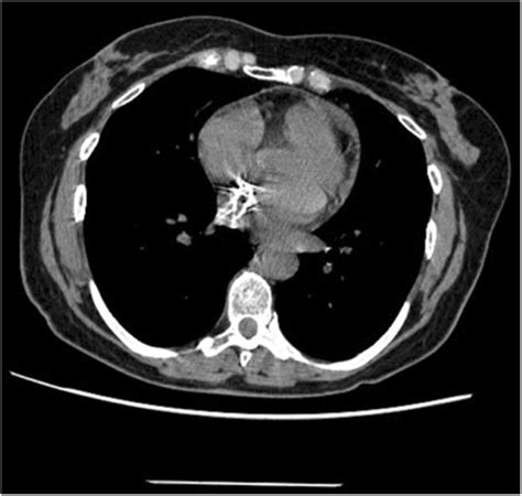 Ct‐scan Revealed The Calcified Lesion In The Left Atrium Download