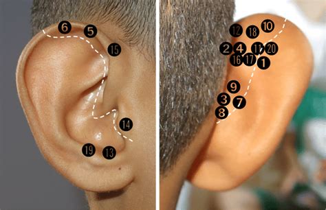 Location Map Of Auricular Dermoid Cysts Each Number Corresponds To The