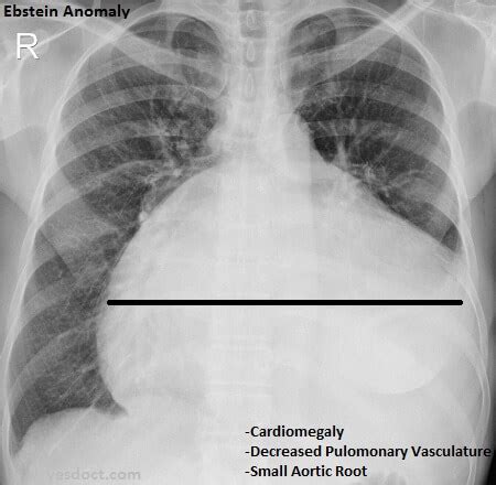 Ebstein Anomaly Symptoms Causes Treatment Yesdoct