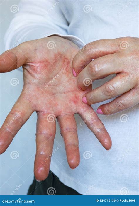 Atopic Dermatitis Red Itchy Hands With Blisters And Chapped Skin