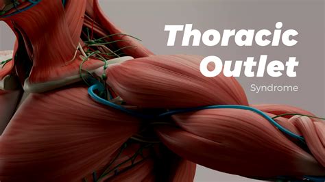 Effective Treatment For Thoracic Outlet Syndrome — Radius Physical