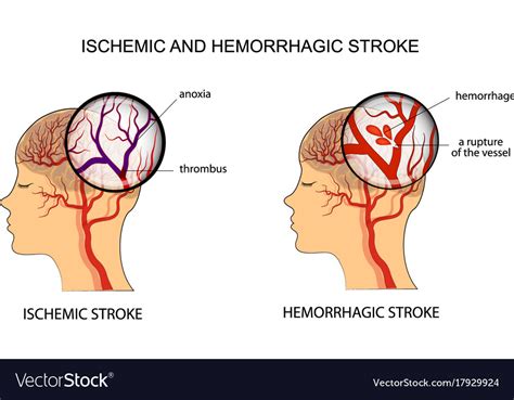Ischemic And Hemorrhagic Stroke Royalty Free Vector Image