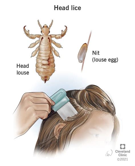 Head Lice Signs Symptoms Causes And Treatment