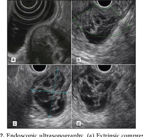 Figure 2 From Endoscopic Ultrasonography And Rectal Duplication Cyst In An Adult Semantic Scholar