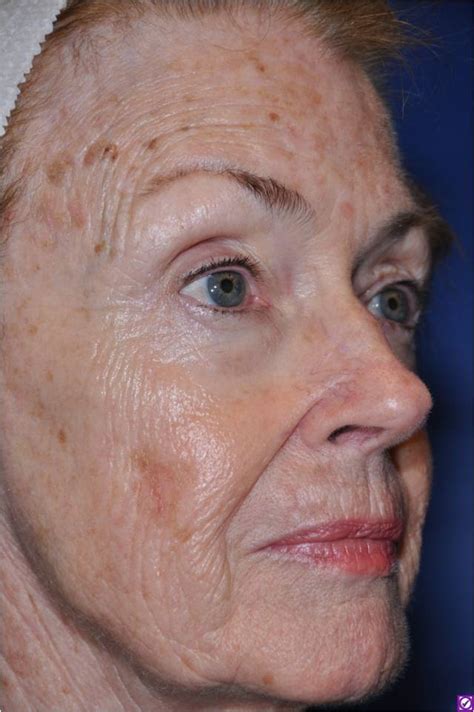 Aging Skin Photoaging Skin The Clinical Advisor