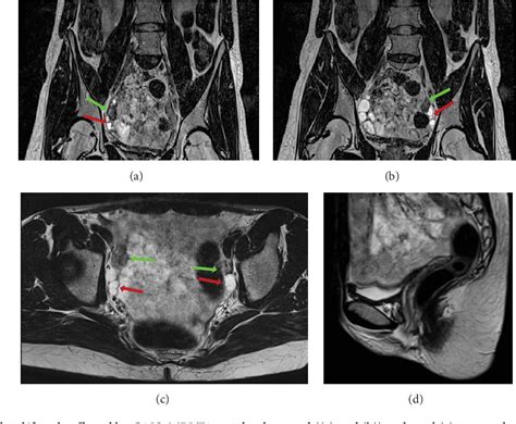 Figure 4 From Role Of Imaging In The Diagnosis And Management Of Complete Androgen Insensitivity