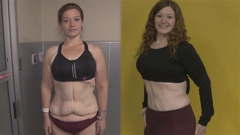 Woman Removes Loose Skin After Shedding Pounds Youtube