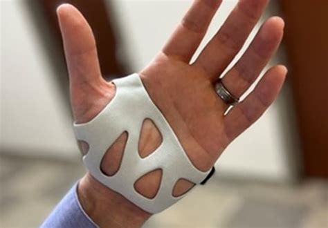 Application Of 3d Printing Technology To The Construction Of Orthoses