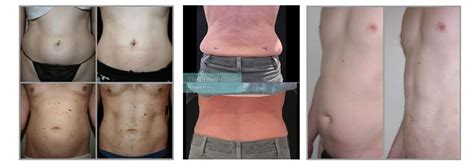 Best Non Surgical Fat Removal Treatment Fat Reduction Non