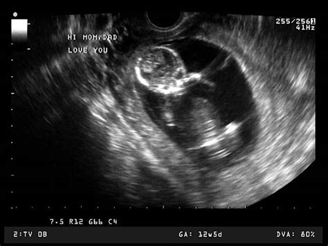 30 Human Pregnancy Ultrasound X Ray Equipment Embryo Stock Photos