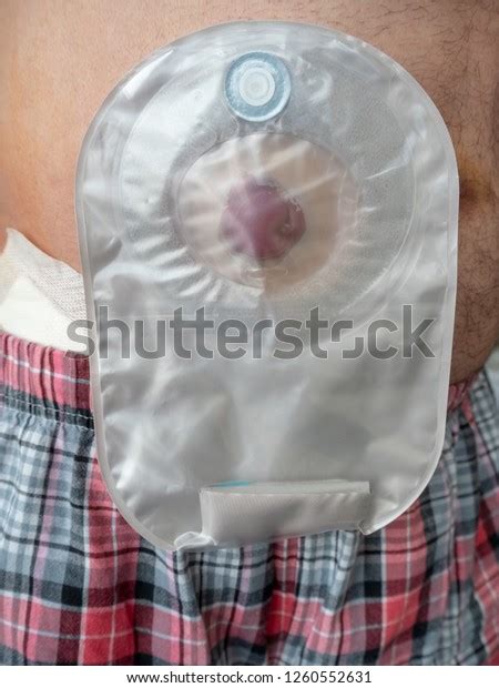 Ileostomy Attached Stomach Patient Closeup Stock Photo 1260552631
