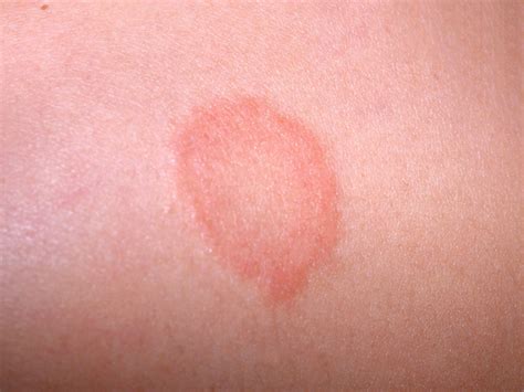 Childhood Rashes Skin Conditions And Infections Photo