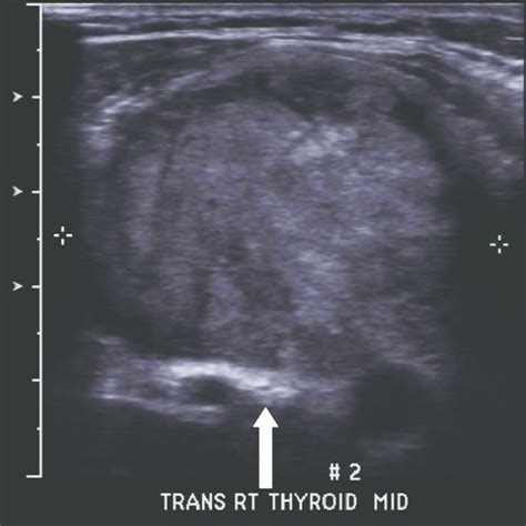 Thyroid Scintigraphy Showing A Dominant Hot Nodule On The Inferior