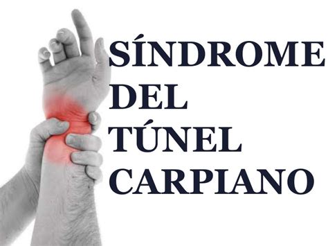 Síndrome Del Túnel Carpiano