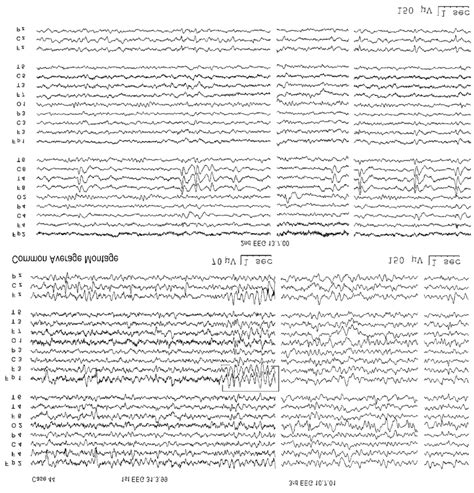 Eegs Of Case 44 With A Pure Autonomic Status Epilepticus Followed By