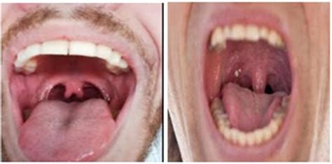 What Does A Normal Healthy Throat Look Like