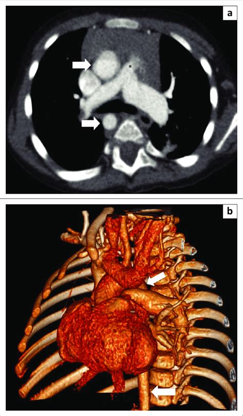 Right Sided Aortic Arch In A Young Boy With Tof Thin Section Axial