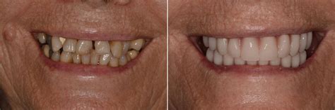 Fotos de Antes y Después de Implantes Dentales All on 4 Pac 1676
