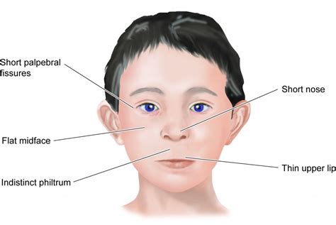 Fetal Alcohol Syndrome Characteristics In Adults
