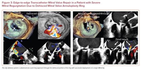 Edge To Edge Transcatheter Mitral Valve Repair In A Patient With Severe