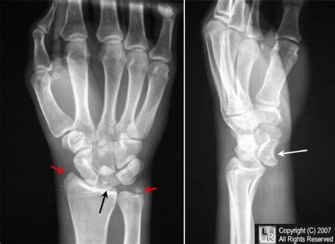 Learning Radiology Lunate Dislocation Perilunate