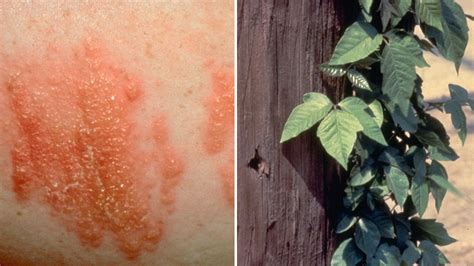 Red And Itchy How To Identify 5 Common Summer Rashes Apple Cider