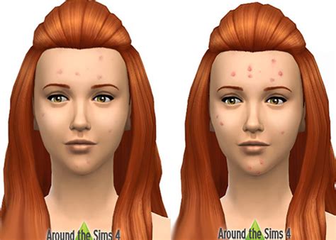 Los Mejores Detalles De Sims 4 Acne Skin Cc Todos Gratis Que Gamer