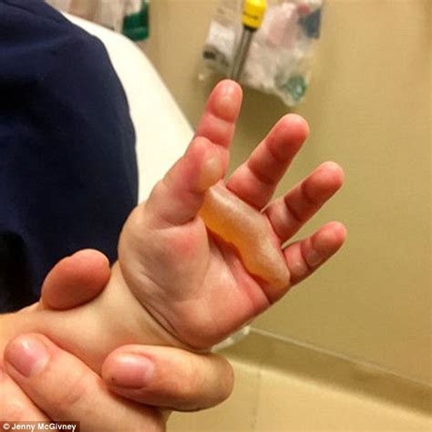 11 Month Old Boy Suffers Burns On Hands From Daycare Door