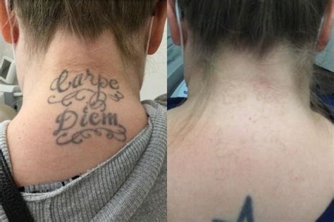 Update More Than 80 Tattoo Laser Removal Before And After Incdgdbentre