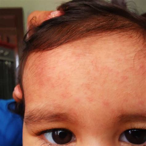 My Baby Has Small Red Rashes At Back Side Of Ear Forehead Lower Areas