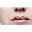 43  Cold Sore On Nose PNG Propranolols