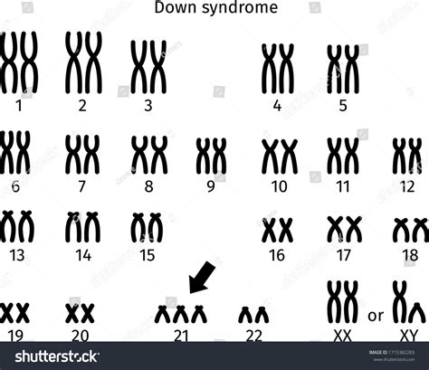 Scheme Of Down Syndrome Karyotype Of Human Royalty Free Stock Vector