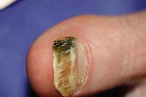 Pseudomonas Nail Infection Bios Pics