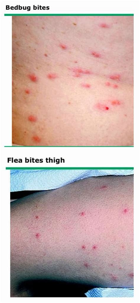 Flea bites and bedbug bites are both treated topically, but there are some differences. How To Tell If You Have Bed Bugs - Heritage Health ...