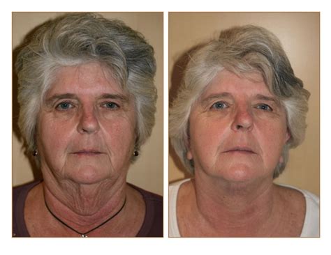 Pictures Face Lift Facelift Lifestyle Lift Orlando Clermont Windemere