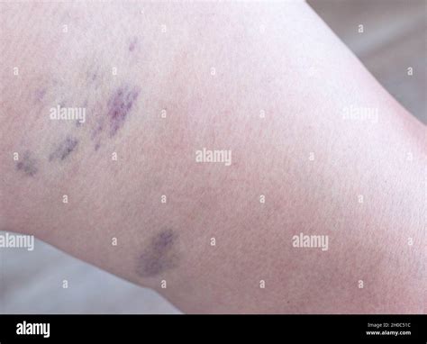 Phlébitis Doctor Hi Res Stock Photography And Images Alamy