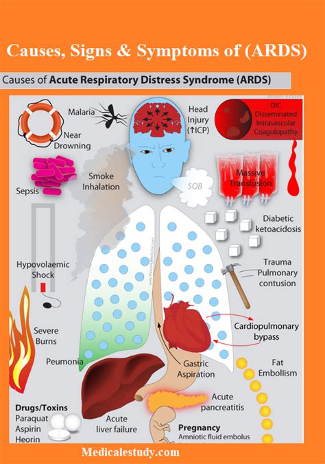 Acute respiratory distress syndrome (ards) is a severe inflammatory reaction of the lungs to pulmonary damage. Causes of Acute respiratory distress syndrome (ARDS ...