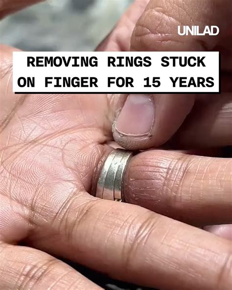 Removing Ring Stuck On Finger For 15 Years The Relief When They Came