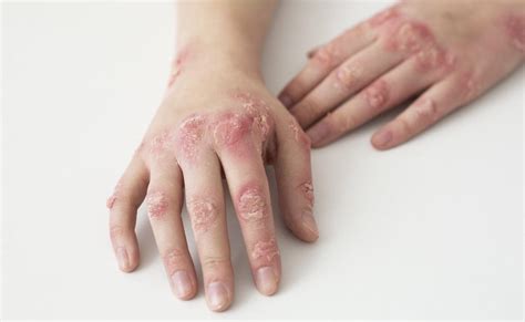 Drug Resistant Ringworm Detected In Us Says Report