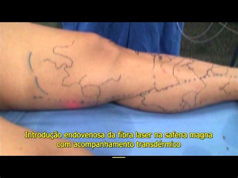 Cirurgia Tratamento De Varizes Laser Dr Eduardo Sisterolli Em Goi Nia Youtube