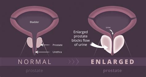 Diagram Of Prostate Gland