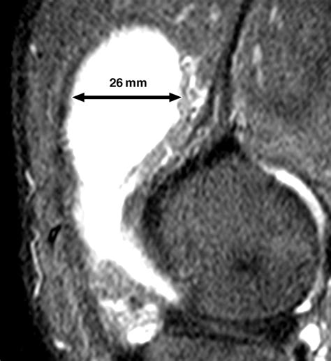 Accuracy Of Cross Table Lateral Knee Radiography For Evaluation Of