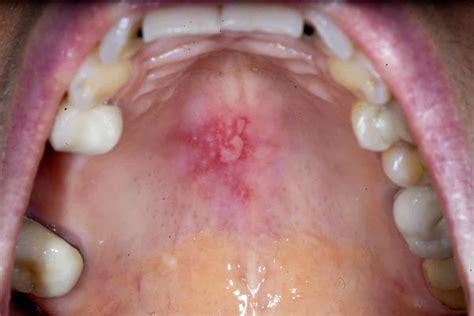 Mouth Ulcer Causes Symptoms Treatment And Cure Museum Dental Center