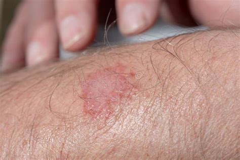 Eczema On The Arm Of A Man Stock Photo Image Of Pain 114063442