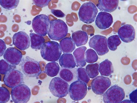 The Gene Processes That Drive Acute Myeloid Leukaemia