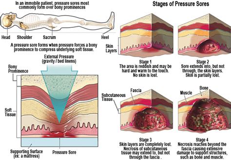 Pressure Ulcers Bed Sores Health Life Media