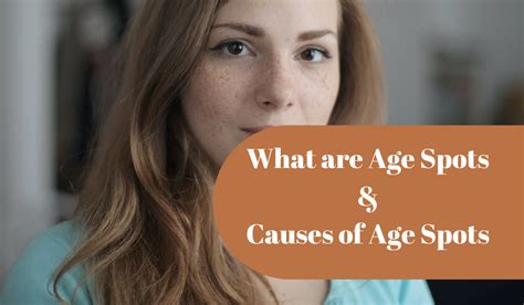 What Are Age Spots Causes Of Age Spots