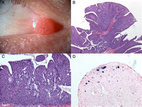 Morphological Characteristics Of Conjunctival Squamous Papillomas In